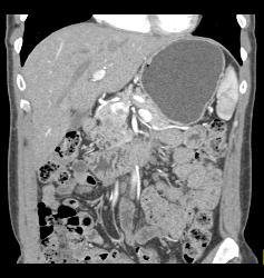 Subtle Islet Cell on Delayed Phase - CTisus CT Scan