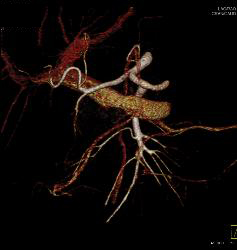 Subtle Islet Cell on Delayed Phase - CTisus CT Scan