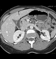 Subtle Islet Cell on Delayed Phase - CTisus CT Scan