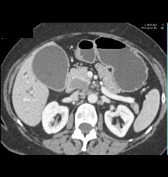 Ampullary Cancer With Nodes - CTisus CT Scan