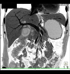 Ampullary Cancer With Nodes - CTisus CT Scan