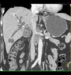 Ampullary Cancer With Nodes - CTisus CT Scan