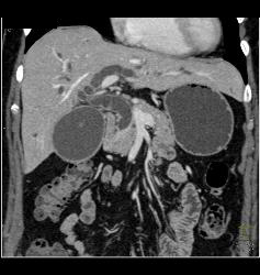 Carcinoma of the Head of the Pancreas - CTisus CT Scan