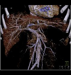 Carcinoma of the Head of the Pancreas - CTisus CT Scan