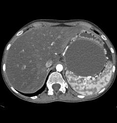 Pseudocyst - CTisus CT Scan