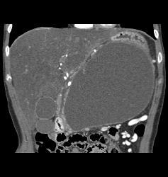 Pseudocyst - CTisus CT Scan