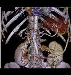 Pseudocyst - CTisus CT Scan