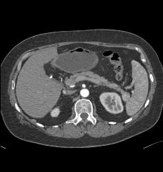 Accessory Spleen Simulates A Pancreatic Mass - CTisus CT Scan