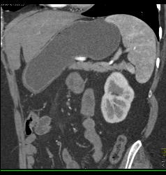 Accessory Spleen Simulates A Pancreatic Mass - CTisus CT Scan