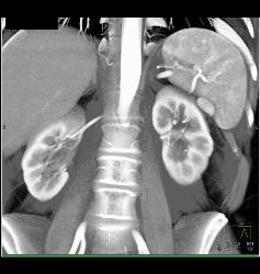 Accessory Spleen Simulates A Pancreatic Mass - CTisus CT Scan