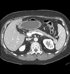 Accessory Spleen Simulates A Pancreatic Mass - CTisus CT Scan