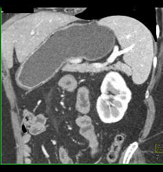 Accessory Spleen Simulates A Pancreatic Mass - CTisus CT Scan