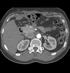 Minimal Fluid S/p Distal Pancreatectomy - CTisus CT Scan