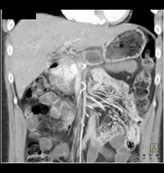 Minimal Fluid S/p Distal Pancreatectomy - CTisus CT Scan