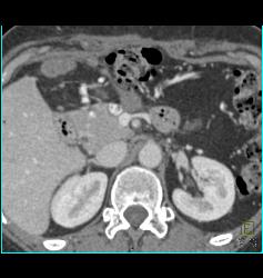 1 Cm Islet Cell - CTisus CT Scan