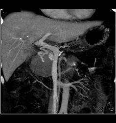 1 Cm Islet Cell - CTisus CT Scan