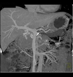 1 Cm Islet Cell - CTisus CT Scan