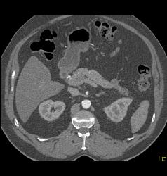 Mass in Mesentery C/w Carcinoid - CTisus CT Scan