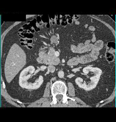 Mass in Mesentery C/w Carcinoid - CTisus CT Scan