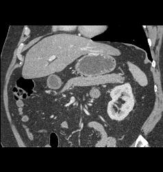 Mass in Mesentery C/w Carcinoid - CTisus CT Scan