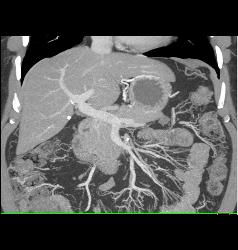 Mass in Mesentery C/w Carcinoid - CTisus CT Scan