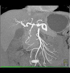 Mass in Mesentery C/w Carcinoid - CTisus CT Scan