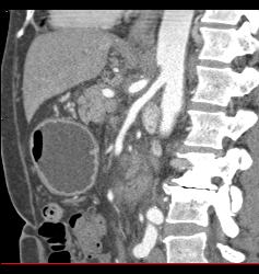 Mass in Mesentery C/w Carcinoid - CTisus CT Scan