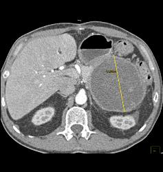 Pseudocyst - CTisus CT Scan