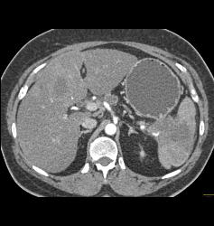 Pancreatic Cancer in Tail With Liver Metastases - CTisus CT Scan