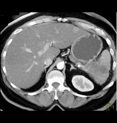 Pseudocyst - CTisus CT Scan