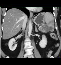 Pseudocyst Involves the Spleen - CTisus CT Scan