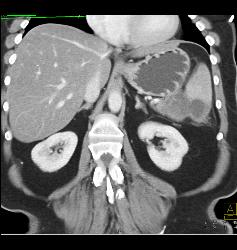 Pseudocyst Involves the Spleen - CTisus CT Scan