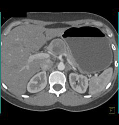 SPEN - CTisus CT Scan