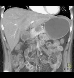 SPEN - CTisus CT Scan