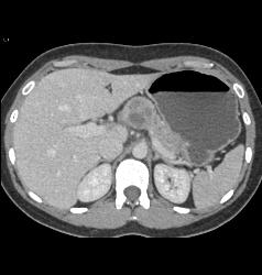 SPEN - CTisus CT Scan