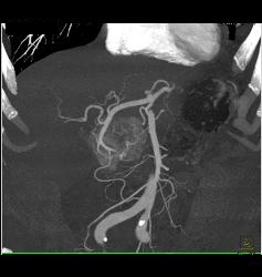 Islet Cell Tumor - CTisus CT Scan