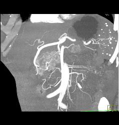 Islet Cell Tumor - CTisus CT Scan