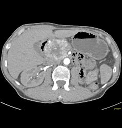 Islet Cell Tumor - CTisus CT Scan