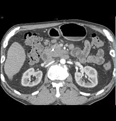 Pancreatic Cancer - CTisus CT Scan