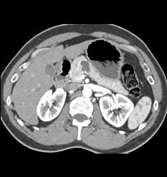 Intraductal Papillary Mucinous Neoplasm (IPMN) - CTisus CT Scan