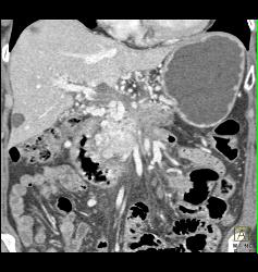 Cavernous Transformation of the Portal Vein (CTPV) and Splenic Vein Occlusion With Tumor Infiltration - CTisus CT Scan