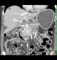 Cavernous Transformation of the Portal Vein (CTPV) and Splenic Vein Occlusion With Tumor Infiltration - CTisus CT Scan