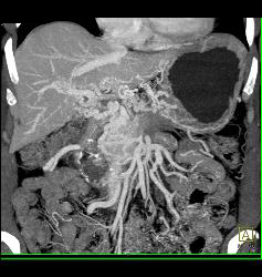 Cavernous Transformation of the Portal Vein (CTPV) and Splenic Vein Occlusion With Tumor Infiltration - CTisus CT Scan