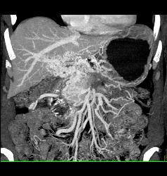 Cavernous Transformation of the Portal Vein (CTPV) and Splenic Vein Occlusion With Tumor Infiltration - CTisus CT Scan