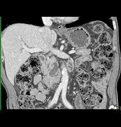 Intraductal Papillary Mucinous Neoplasm (IPMN) - CTisus CT Scan