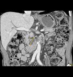 Intraductal Papillary Mucinous Neoplasm (IPMN) - CTisus CT Scan