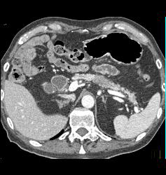 Subtle Tumor in Body of Pancreas - CTisus CT Scan