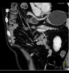 Subtle Tumor in Body of Pancreas - CTisus CT Scan