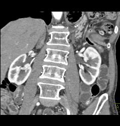 Subtle Tumor in Body of Pancreas - CTisus CT Scan