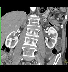 Intraductal Papillary Mucinous Neoplasm (IPMN) - CTisus CT Scan